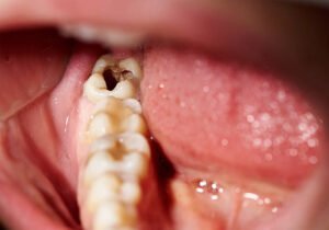 ڈاڑھ میں کیڑا لگنے اور کیویٹی (Cavity) کا قدرتی علاج