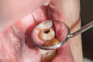 دانت میں کیڑا لگنے اور کیویٹی کی علامات اور علاج